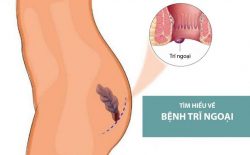 Trĩ ngoại là ảnh hưởng đến cuộc sống của bệnh người bệnh 