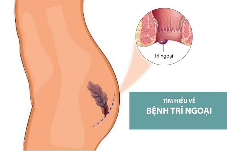 Trĩ ngoại là ảnh hưởng đến cuộc sống của bệnh người bệnh 