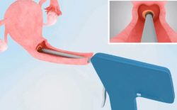 Phương pháp áp lạnh chữa viêm lộ tuyến cổ tử cung
