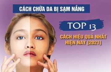 Cách chữa da bị sạm nắng