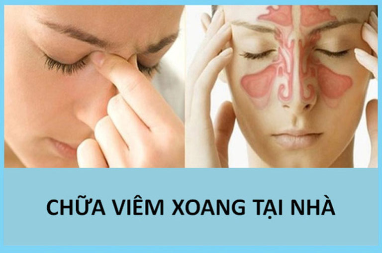 Hiện nay có nhiều mẹo chữa viêm xoang tại nhà vẫn được người bệnh tin dùng