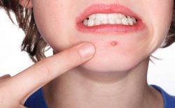 Cách trị mụn trứng cá tại nhà