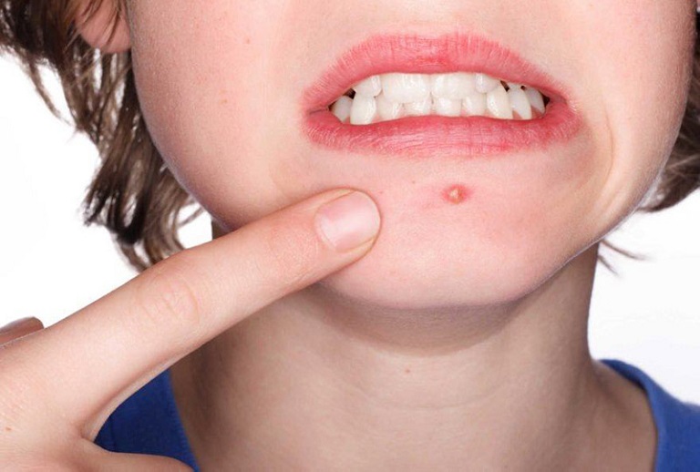 Cách trị mụn trứng cá tại nhà