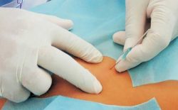 Cấy chỉ là gì? Quy trình, chi phí, địa chỉ cấy chỉ AN TOÀN nhất hiện nay