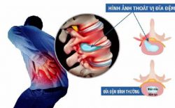 Châm cứu thoát vị đĩa đệm KHÔNG CẦN PHẪU THUẬT? Địa chỉ UY TÍN, GIÁ RẺ
