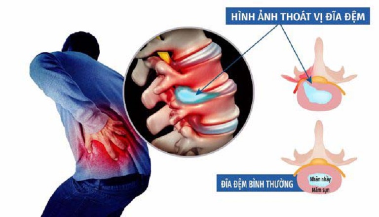Châm cứu thoát vị đĩa đệm KHÔNG CẦN PHẪU THUẬT? Địa chỉ UY TÍN, GIÁ RẺ