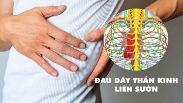 Đau dây thần kinh liên sườn