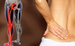 Có nhiều nguyên nhân gây tình trạng đau dây thần kinh tọa