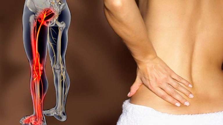 Có nhiều nguyên nhân gây tình trạng đau dây thần kinh tọa