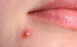 Hình ảnh mụn mủ trên da