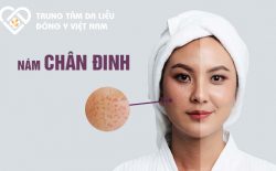 Nám chân đinh rất dễ nhận biết