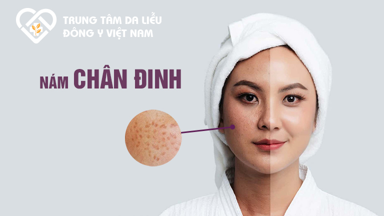 Nám chân đinh rất dễ nhận biết