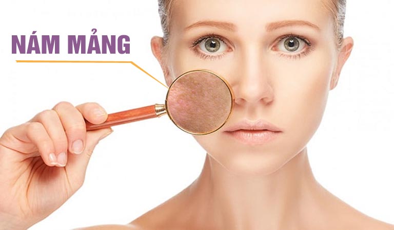 Nám mảng