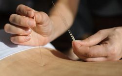 Châm cứu có nhiều ưu điểm vượt trội