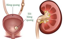 Hình ảnh mô phỏng sỏi bàng quang