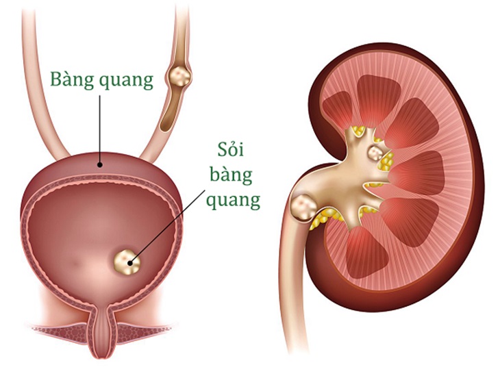 Hình ảnh mô phỏng sỏi bàng quang