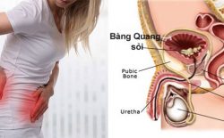 Sỏi bàng quang và nguyên nhân gây bệnh