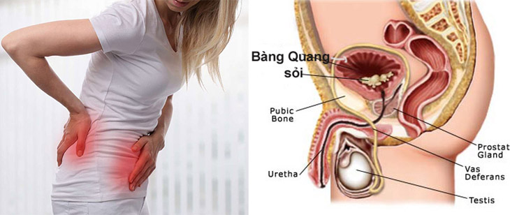 Sỏi bàng quang và nguyên nhân gây bệnh