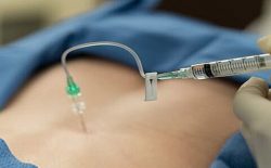 Kết hợp thủy châm với châm cứu khi điều trị thoát vị đĩa đệm