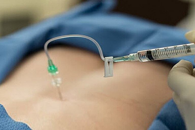 Kết hợp thủy châm với châm cứu khi điều trị thoát vị đĩa đệm