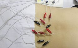 Điện châm là phương pháp chữa bệnh không dùng thuốc được nhiều bệnh nhân sử dụng