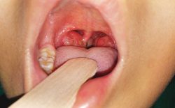 Viêm amidan cấp là tình trạng nhiễm trùng tự giới hạn xảy ra ở 1 hoặc 2 amidan