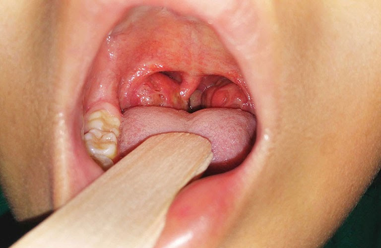 Viêm amidan cấp là tình trạng nhiễm trùng tự giới hạn xảy ra ở 1 hoặc 2 amidan