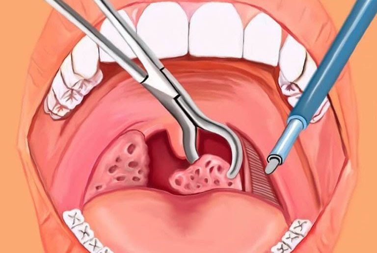 Cắt amidan là một trong những phương pháp điều trị viêm amidan được áp dụng phổ biến