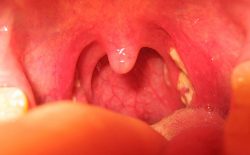 Bệnh viêm amidan hốc mủ có thể gây ra nhiều biến chứng nguy hiểm đến sức khỏe, thậm chí đe dọa đến tính mạng