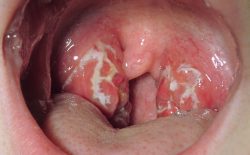 Viêm amidan mãn tính là bệnh lý nghiêm trọng cần chú ý điều trị và chăm sóc đúng cách