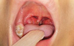 Viêm amidan là một bệnh lý xảy ra phổ biến ở trẻ nhỏ khiến amidan sưng to rất khó chịu
