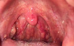 Viêm họng hạt (viêm họng quá phát) là thể lâm sàng của viêm họng mãn tính