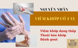Nguyên nhân dẫn đến viêm sưng tại khớp cổ tay do thoái hóa