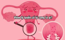 Viêm lộ tuyến cổ tử cung là gì?