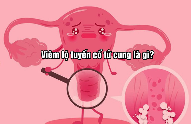 Viêm lộ tuyến cổ tử cung là gì?