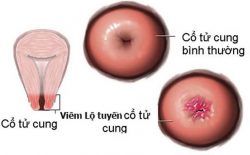 Hình ảnh viêm lộ tuyến cổ tử cung độ 1