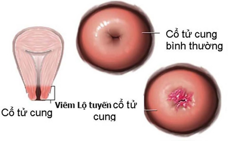Hình ảnh viêm lộ tuyến cổ tử cung độ 1