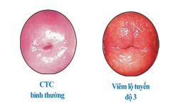 Viêm lộ tuyến độ 3 là tình trạng viêm nhiễm đã chiếm gần hết hoặc toàn bộ phần cổ tử cung