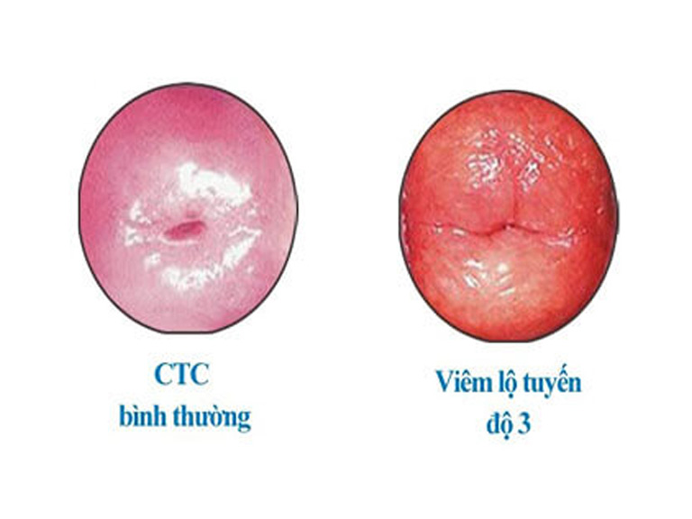 Viêm lộ tuyến độ 3 là tình trạng viêm nhiễm đã chiếm gần hết hoặc toàn bộ phần cổ tử cung