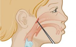 Viêm VA có 2 dạng gồm viêm VA cấp tính và viêm VA mạn tính