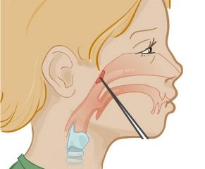 Viêm VA có 2 dạng gồm viêm VA cấp tính và viêm VA mạn tính