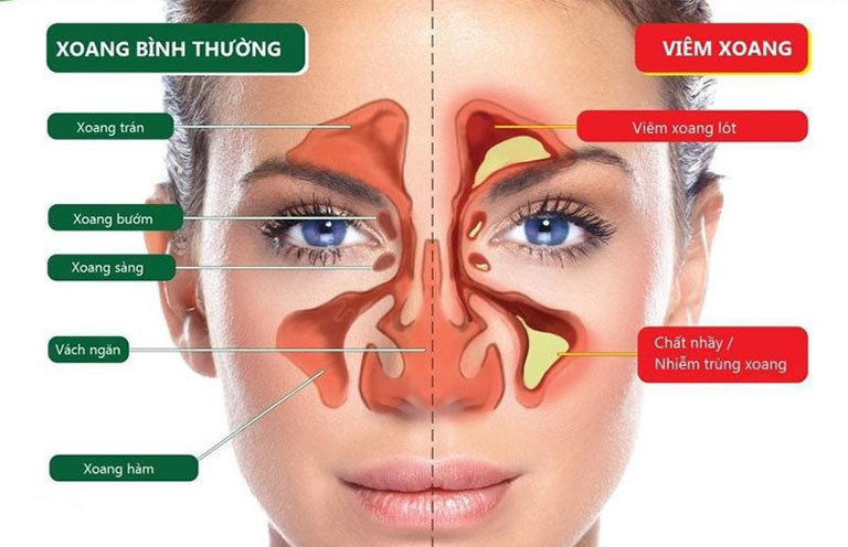 Hiện có nhiều bệnh nhân bị viêm xoang cấp