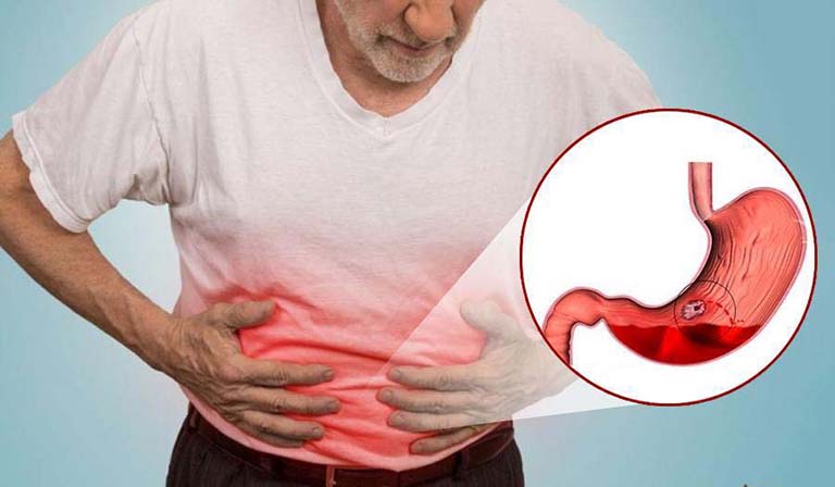 Xuất Huyết Dạ Dày Là Gì? Cách Xử Lý Bệnh Tốt Nhất Hiện Nay