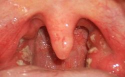 Viêm họng hạt gây nhiều ảnh hưởng đến sức khỏe