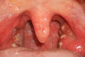 Viêm họng hạt gây nhiều ảnh hưởng đến sức khỏe