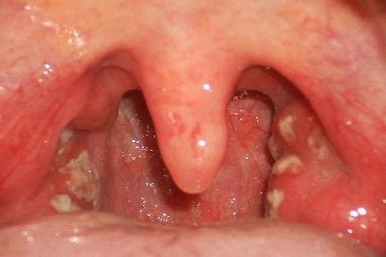 Viêm họng hạt gây nhiều ảnh hưởng đến sức khỏe