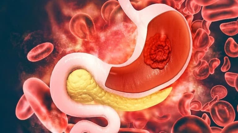 Vị trí đau dạ dày nằm ở đâu và giải pháp nhanh gọn nhất từ YHCT