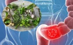Cách chữa bệnh đại tràng tại nhà hiệu quả