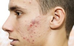 Cách trị mụn bọc