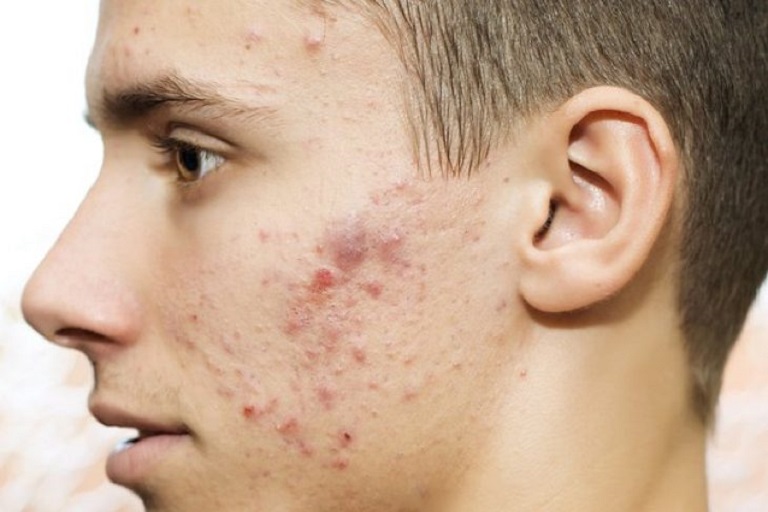 Cách trị mụn bọc